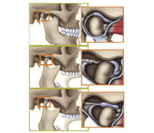 Clicky-or-Clicking-Jaw-(TMJ)-blog